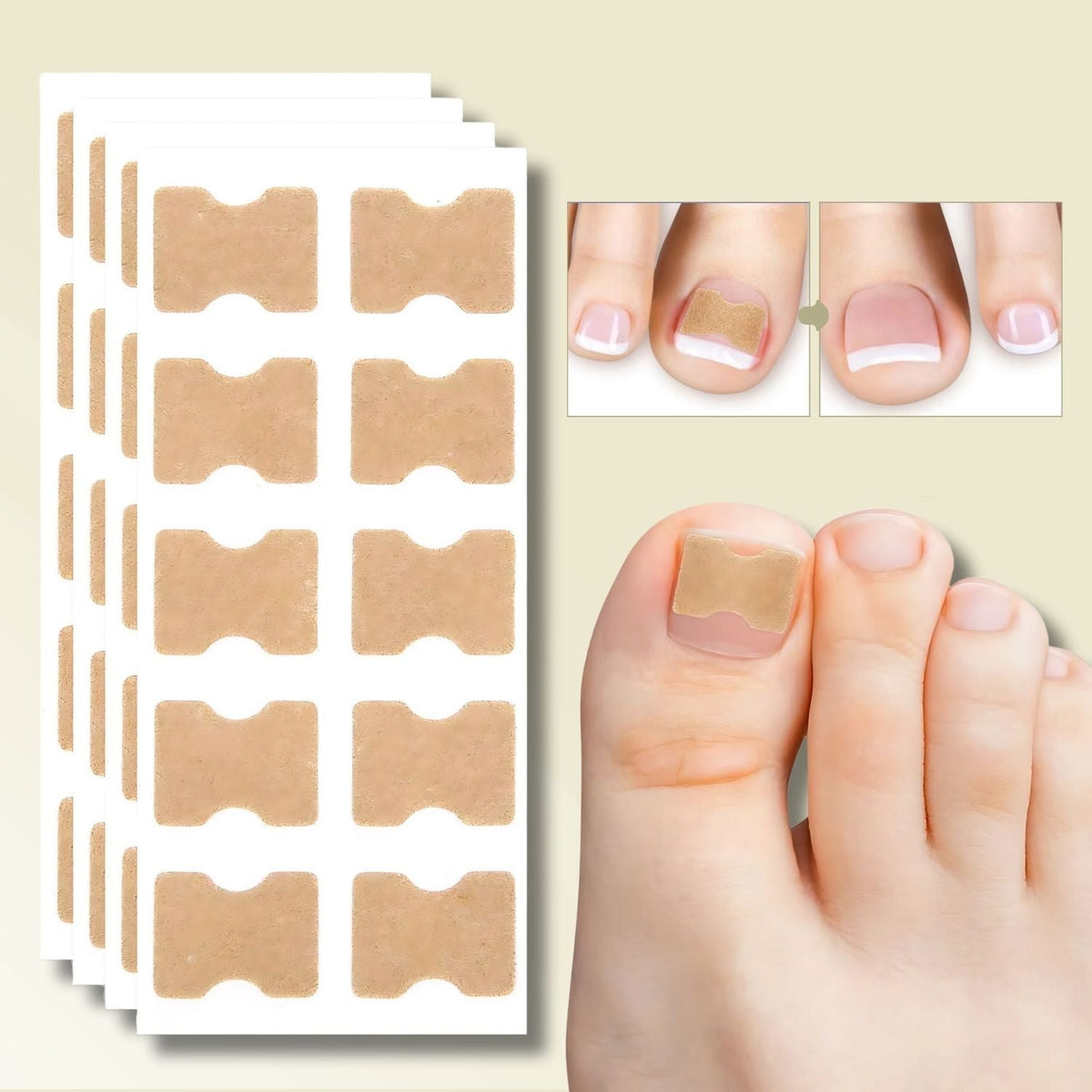 Nagelreparatiepleisters Voor Ingegroeide Nagels - 10 Stuks 0