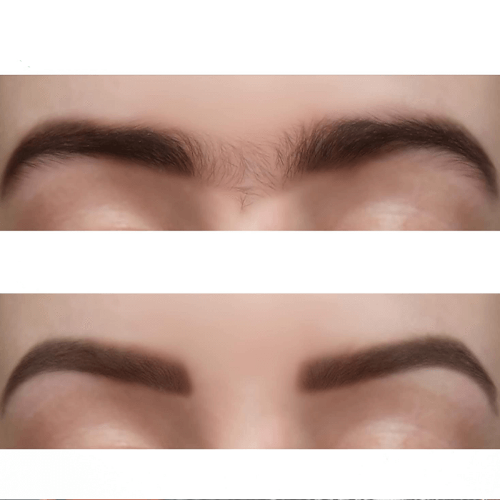 Perzikpluis verwijderaar